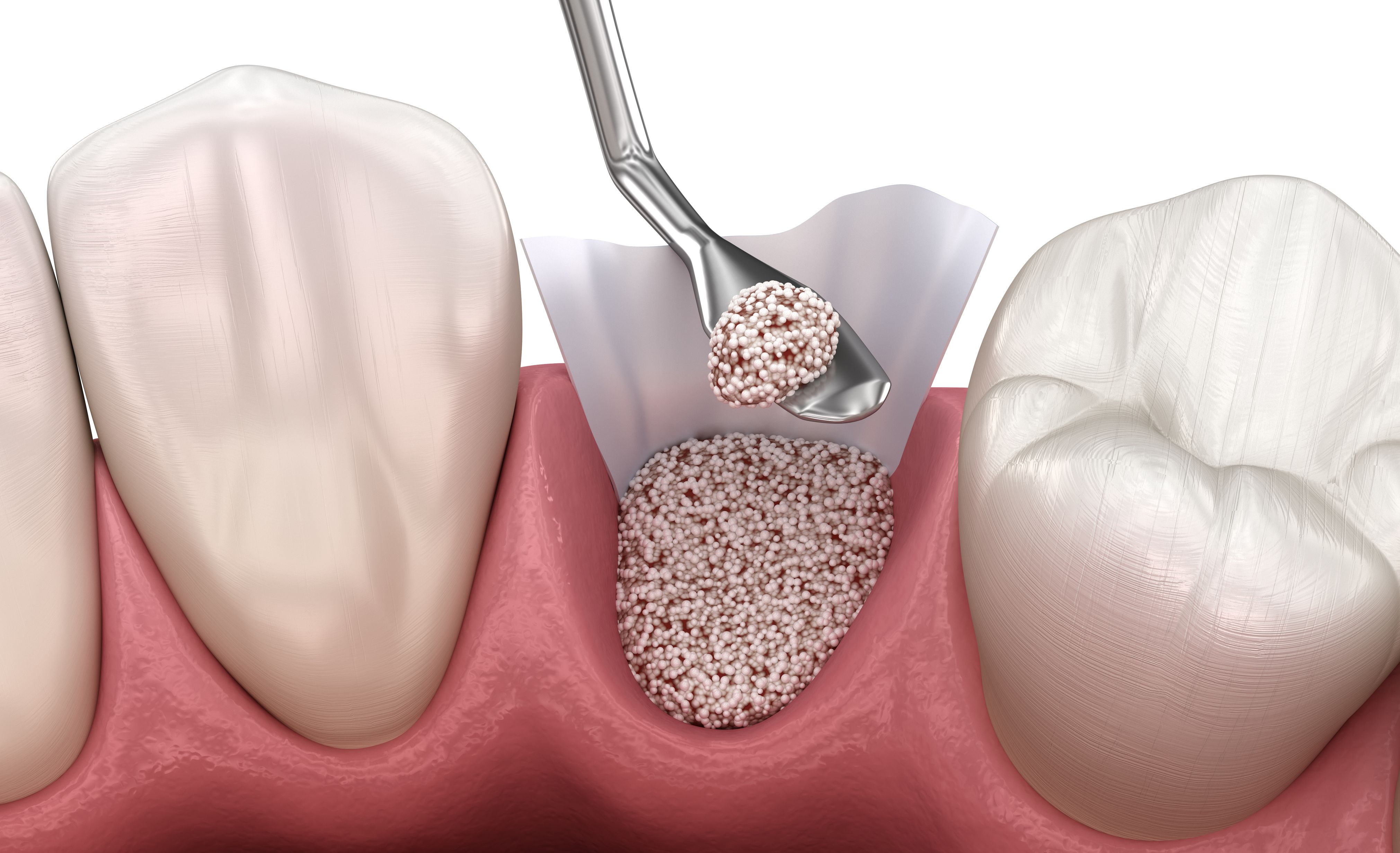 knochenaufbau-kiefer