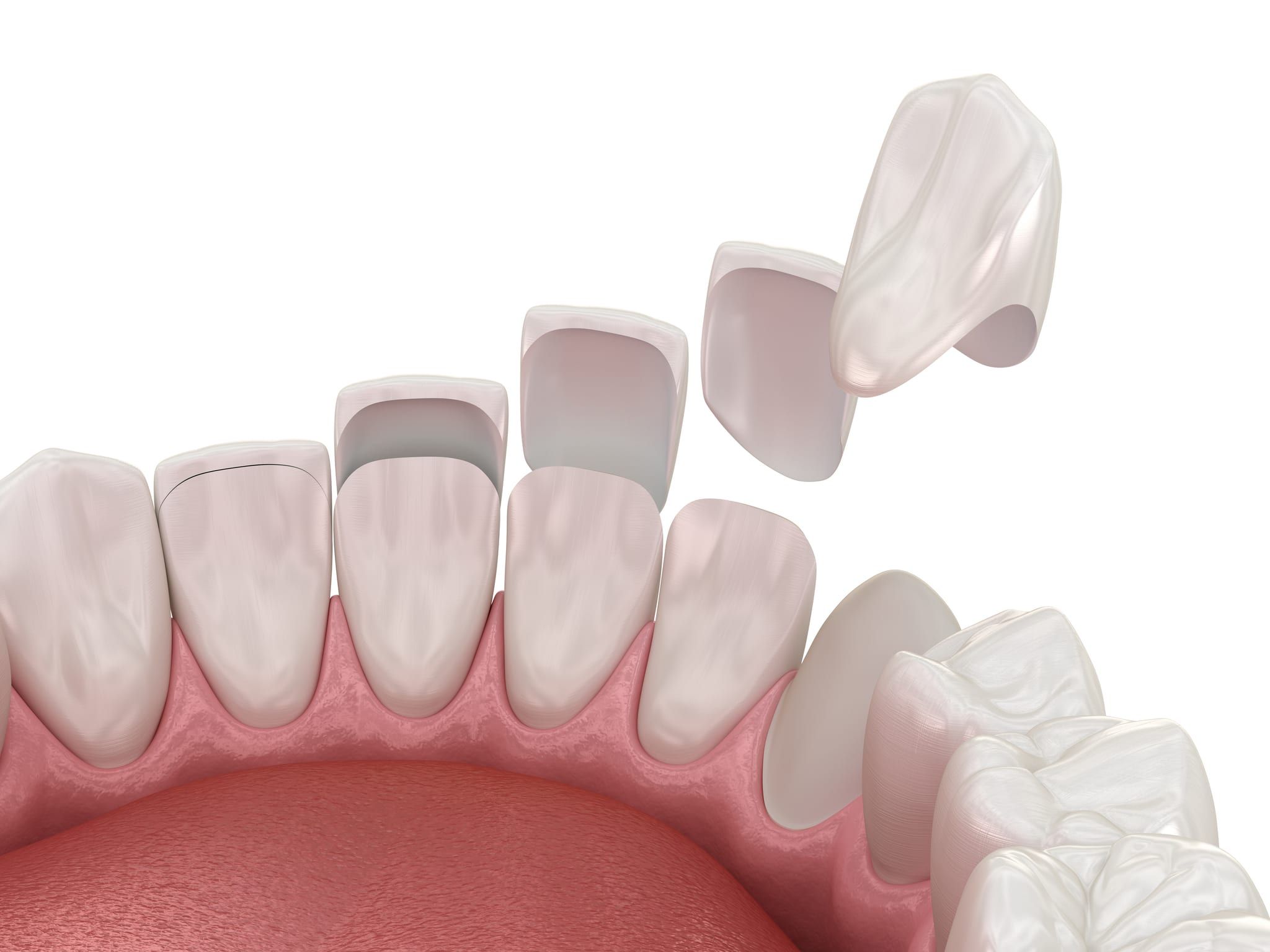 veneers